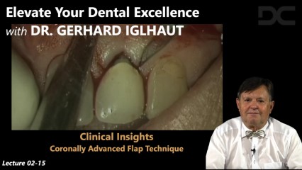 Clinical insights: coronally advanced flap technique